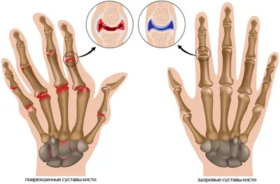 Артроз суставов пальцев рук: фото для учебника медицины