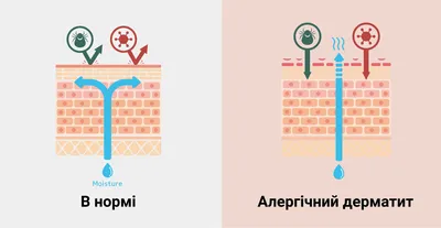 Изображение атопического дерматита на руке: с подписью