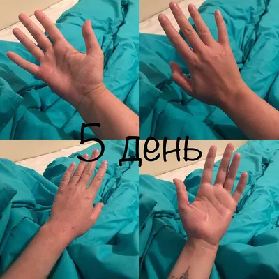 Фото атопического дерматита на руках: с информацией о лечении
