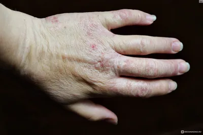 Картинка атопического дерматита на руках для диагностики