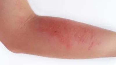 Фото атопического дерматита на руках с подробным описанием