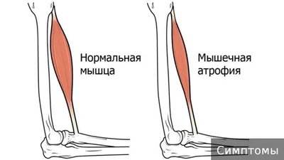 Атрофия мышц руки: фото для медицинских целей