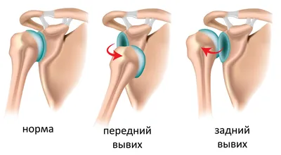 Картинка атрофии мышц руки: как диагностировать дома