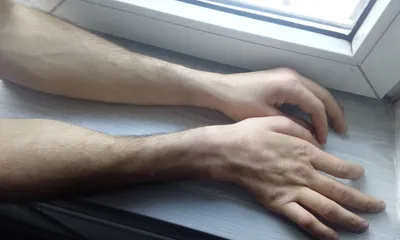 Картинка атрофии мышц руки в высоком качестве