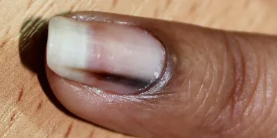 Белые пятна на ногтях рук: фото для медицинских статей