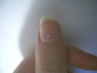 Изображение белых пятен на ногтях рук: как справиться с проблемой
