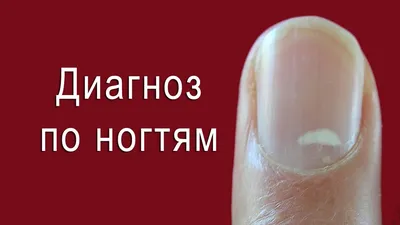 Фото белых пятен на ногтях рук: как правильно ухаживать за ногтями