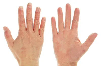 Руки с белыми пятнами: фотография с эффектом