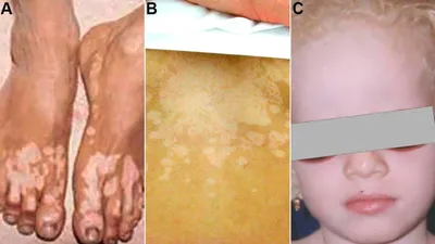 Руки с белыми пятнами: фото с консультацией дерматолога