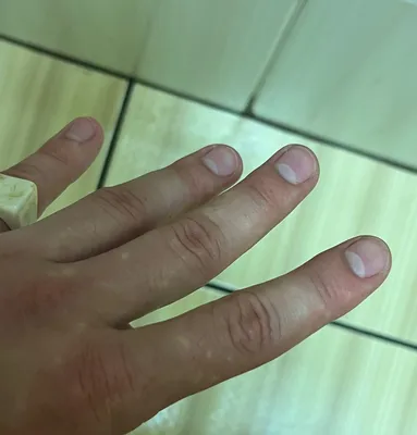 Белые пятна на коже рук: фотография с рекомендациями по использованию солнцезащитных средств