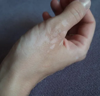 Белые пятна на коже рук: фотография в формате JPG