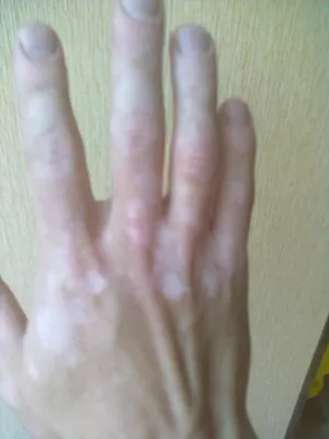 Фото белых пигментных пятен на руках для медицинского диагноза