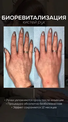 Биоревитализация рук: красота и здоровье кожи
