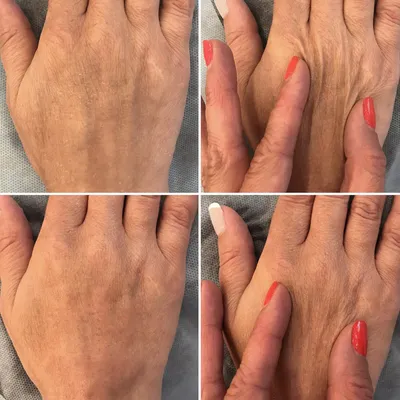 Изображения эффекта биоревитализации рук