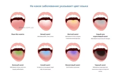 Бактериальная Инфекция Заболевания Языка — стоковые фотографии и другие  картинки Анемия - Анемия, Молочница - инфекция, Ребёнок - iStock