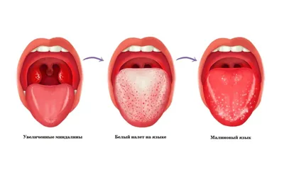 Налет на языке: нужно ли паниковать, к кому обратиться за лечением — D.Ante