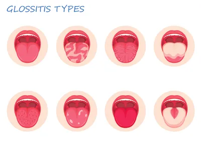 Болезни Языка В Картинках фотографии