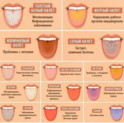 Стоматит - виды, причины, диагностика, методы лечения