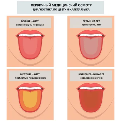 Белый налет на языке у взрослого или ребенка - причины появления, лечение  заболеваний, обратиться к врачу, если обложен язык