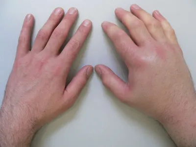Болезни кистей рук: фото и массаж для лечения