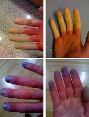Картинки болезней кистей рук для скачивания