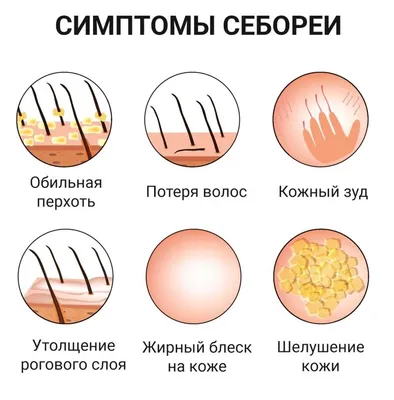 Почему появляется перхоть? 6 главных причин. Как избавиться от перхоти –  рассказывает врач-трихолог | CHARISMO. Журнал о здоровье волос | Дзен