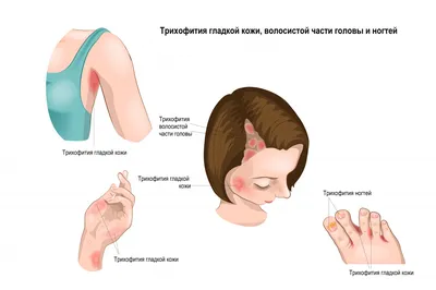 Себорейный дерматит: на голове и лице, лечение, симптомы, жирная и сухая  формы, причины