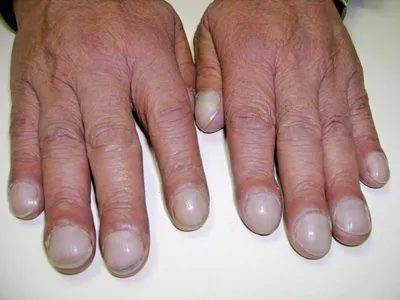 Опасные заболевания кожи рук на изображениях