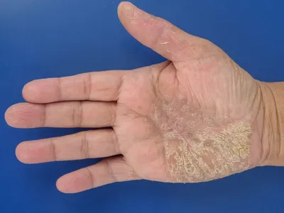 Изображения крапивницы на коже рук