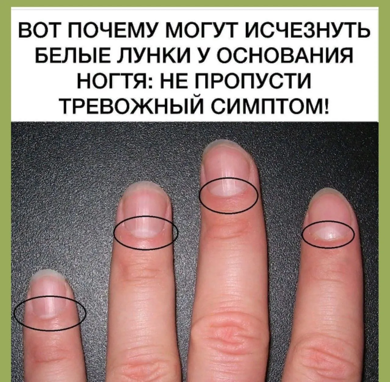 Какие болезни можно узнать по ногтям на руках фото