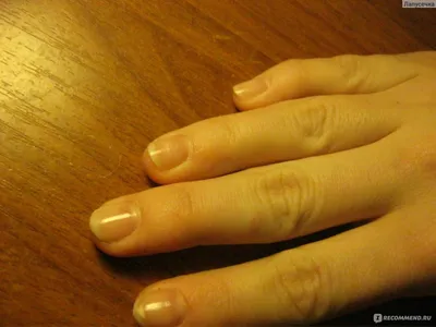 Фото ногтевых заболеваний на руках для диагностики