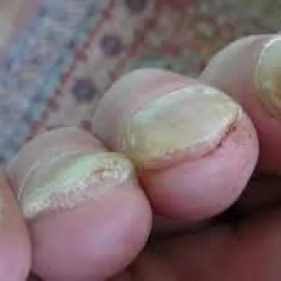 Изображения травм ногтей на руках