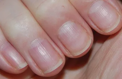 Фотографии лечения болезней ногтей на руках