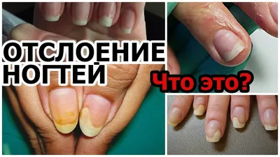 Фото разных форм болезней ногтей на руках