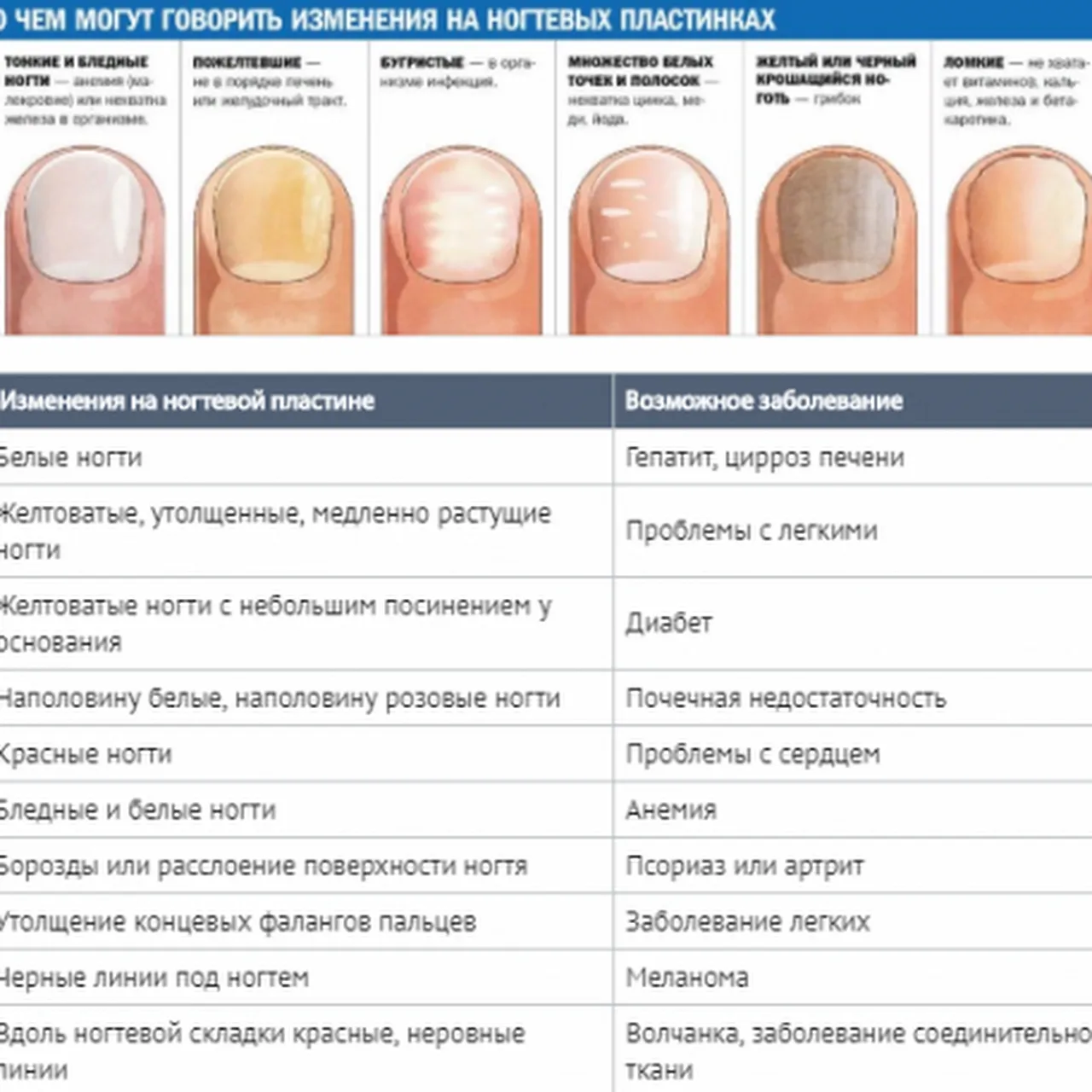 Определение болезни по состоянию ногтей