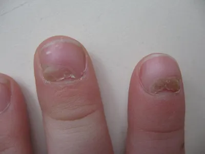 Картинки заболеваний ногтей на руках при аутоиммунных заболеваниях
