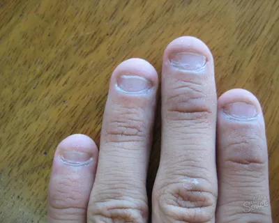 Фотографии заболеваний ногтей на руках при гормональных нарушениях