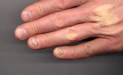 Фотографии заболеваний ногтей на руках при нарушении обмена веществ