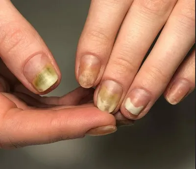 Изображения заболеваний ногтей на руках при наследственной предрасположенности