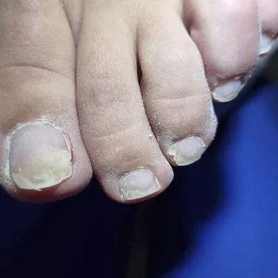 Фото заболеваний ногтей на руках при неизвестной этиологии