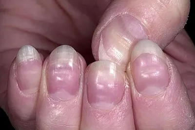 Изображения болезней ногтей на руках