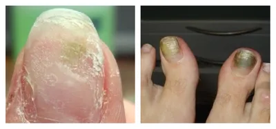 Изображения грибковых инфекций ногтей на руках