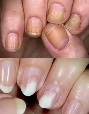 Фото вросших ногтей на руках