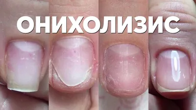 Фотографии дистрофии ногтей на руках