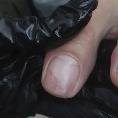 Фотографии болезней ногтевой пластины