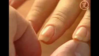 Болезни ногтей рук: фото для диагностики