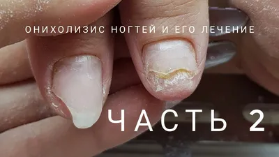 Фото грибковых заболеваний ногтей рук в формате WebP