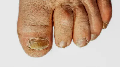 Фотографии болезней ногтей рук для медицинских целей