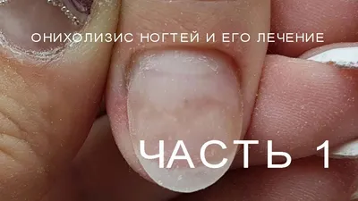 Изображения симптомов псориаза ногтей рук