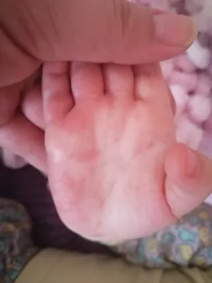 Изображение кожных высыпаний на руках малыша